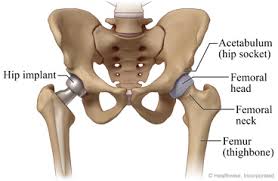 Hip replacement surgery cost in India