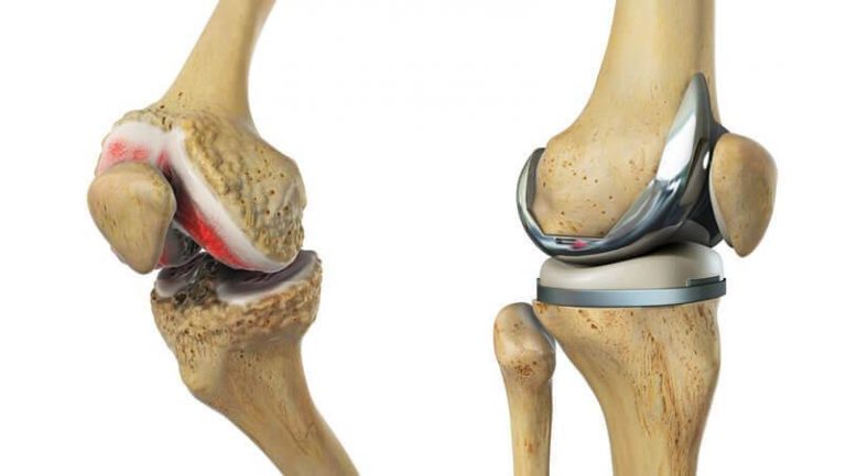 Post Traumatic arthritis- one of the most common reasons for knee replacement