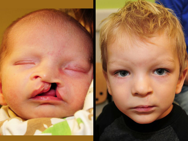The Goal of cleft lip surgery