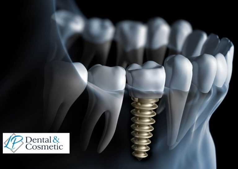 Technologies Involved Improvising the Oral Fixation Techniques