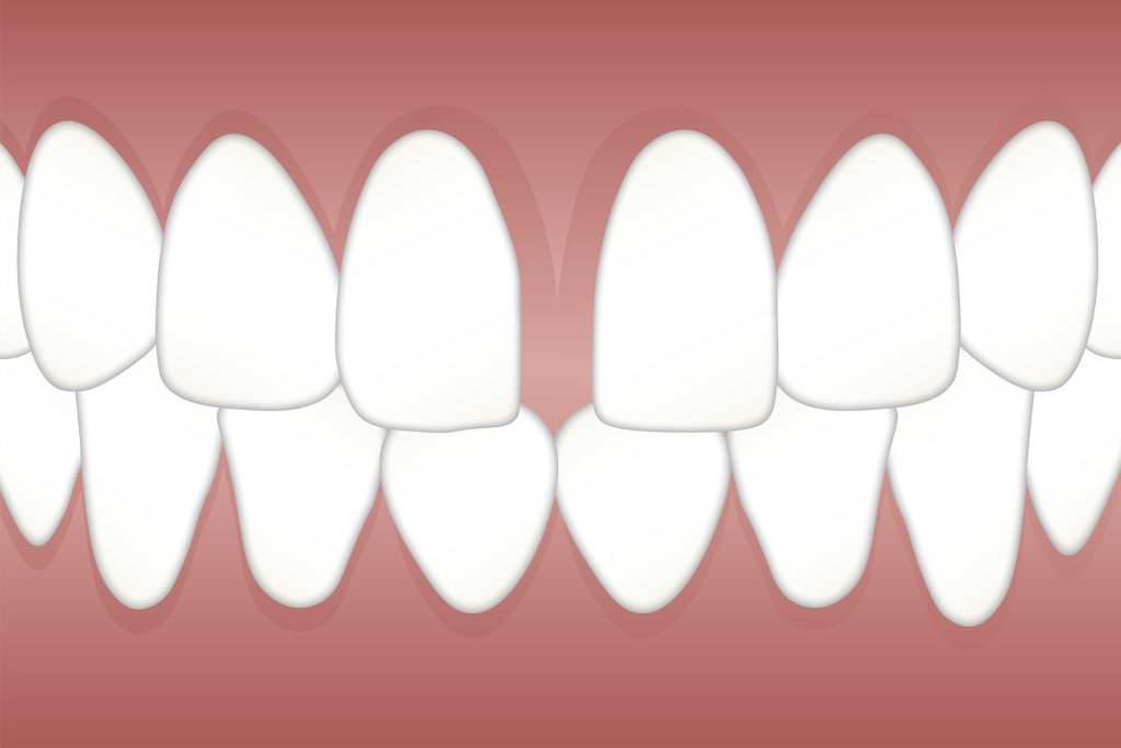 dental bridges