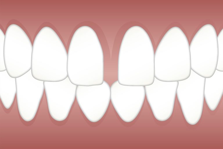 Anchoring Adverse Gaps of Lost Teeth with Dental Bridges