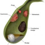 gallbladder stone treatment