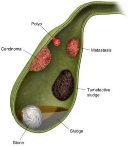 Gallbladder Stone treatment in Surat: What can you expect during the diagnosis and treatment?