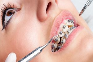 Dental Braces to Fix Affected Oral Health