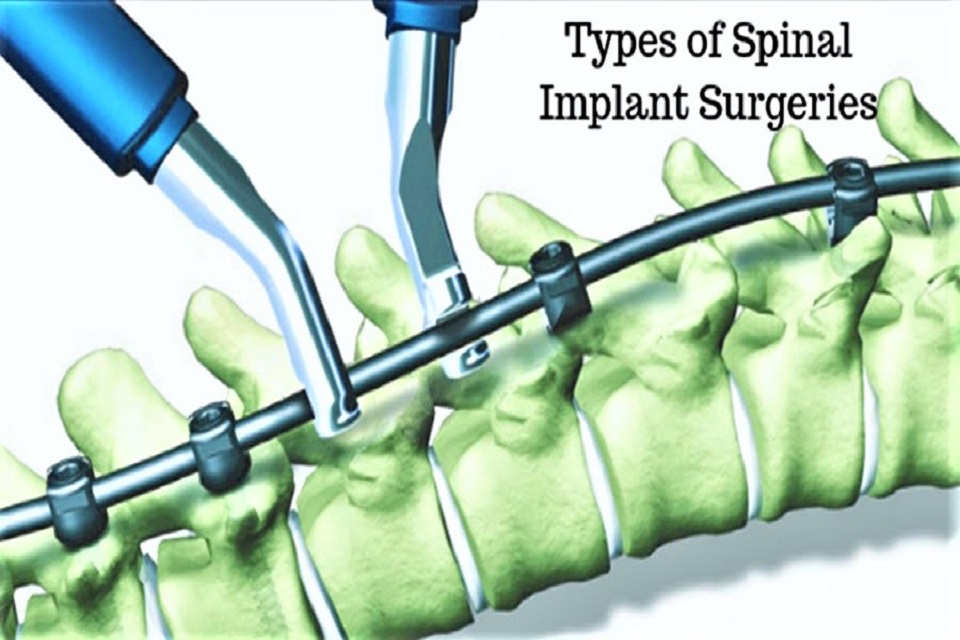 spinal Implant surgeries