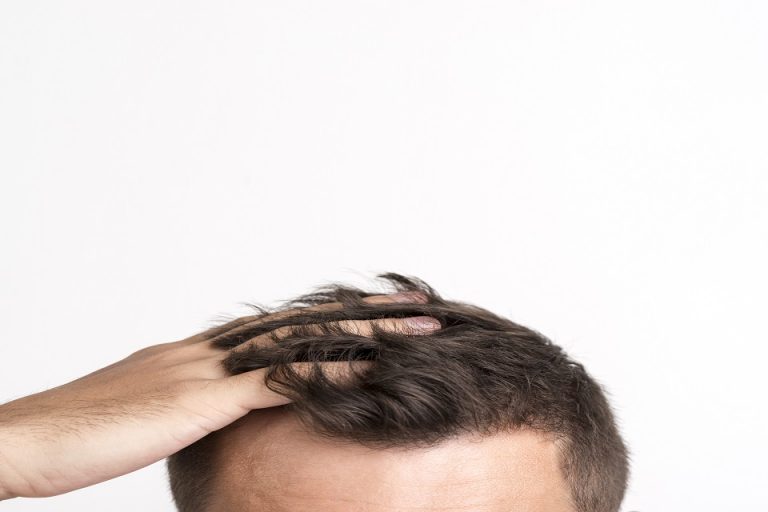 Baldness the hair transplant explained without taboos