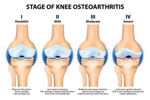 Why You Should Prefer Knee Replacement Surgery
