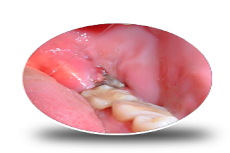 The Symptoms and Treatments for Wisdom Tooth Infection