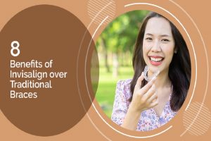 8 Benefits of Invisalign over Traditional Braces