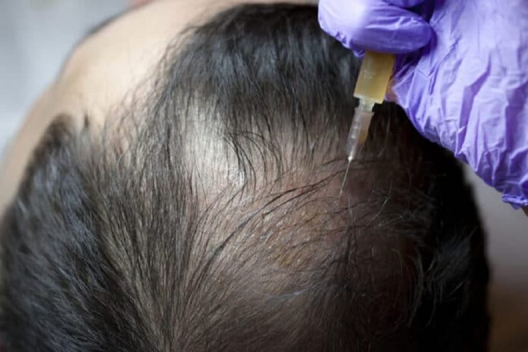 All about PRP Hair Treatment