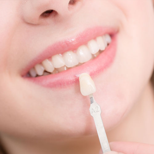 What are dental veneers and why is it important?