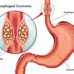 esophagus cancer treatment in Kolkata