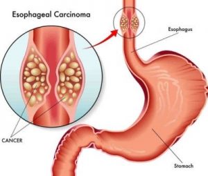 All You Need To Know About Esophageal Cancer: Causes, Symptoms, And Treatment