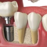 dental implants