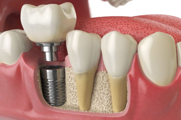 Dental Implants and Teeth Whitening – Schedule Your Implants Carefully To Maintain Healthy Teeth and Gums