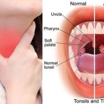 Tonsil infection Surgery In Chennai.