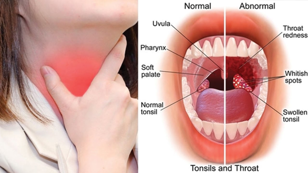 Tonsil infection Surgery In Chennai.