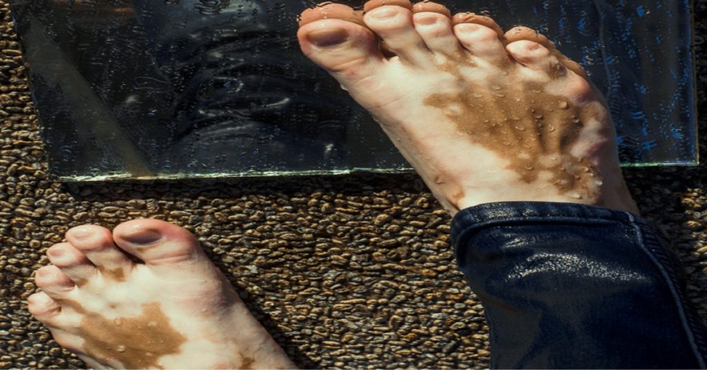 Vitiligo Specialists