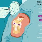 Arthroscopic Surgery