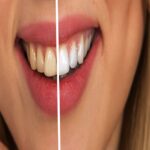 achieving youthful smile