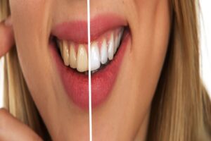 The Best Hacks for Achieving a Youthful Smile