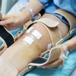 ACL ligament surgery in delhi