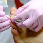 ingrown toenail treatment