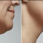 loose neck skin remedies