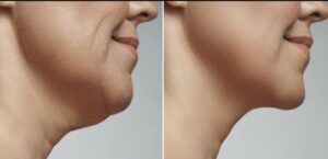 Loose Neck Skin Remedies – Best Topical treatments