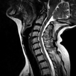 Things to Know About Your Cervical Spine MRI