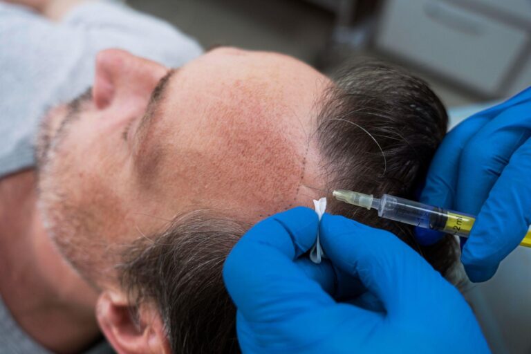 Non-Surgical Hair Transplant: The Future of Hair Restoration?