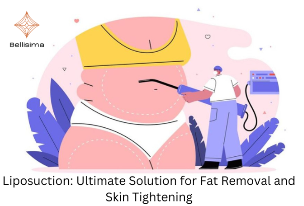 Liposuction: The Ultimate Solution for Fat Removal and Skin Tightening