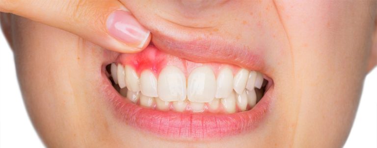 Exposing the Risks and Offering Remedies: Gum Disease