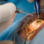 phacoemulsification surgery