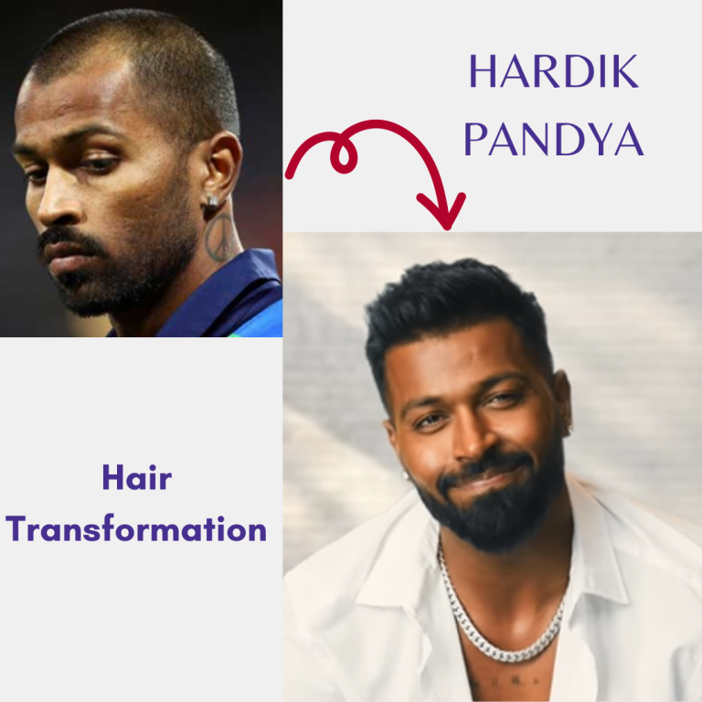 Hardik Pandya’s Hair Transformation Through Transplant