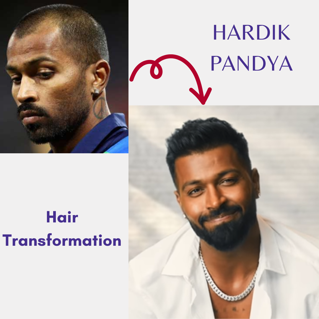 fue hair transplant method