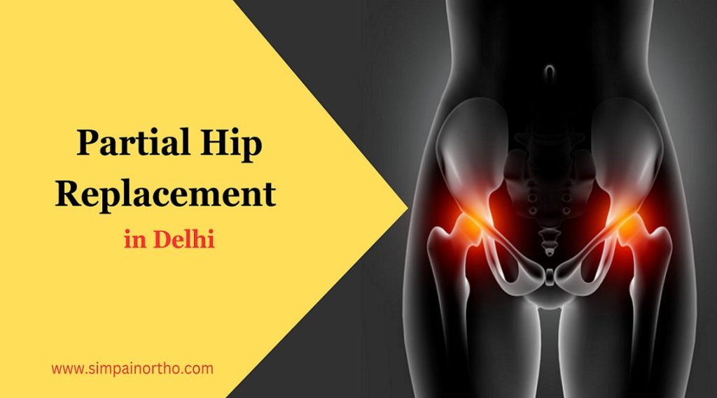 hip replacement surgery