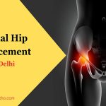 hip replacement surgery