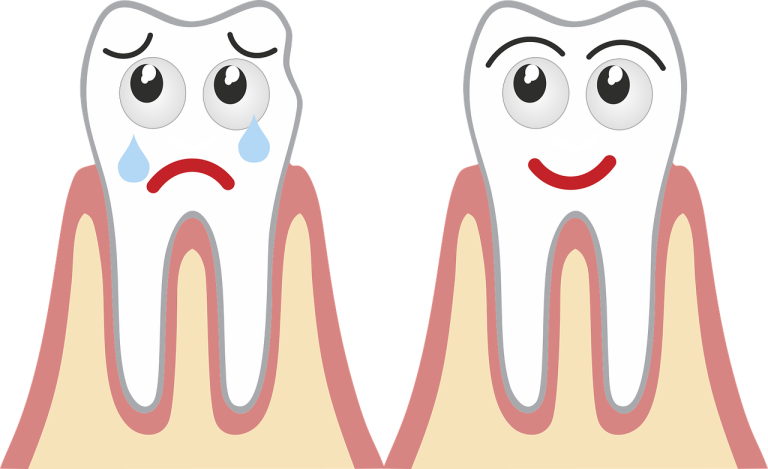 Everything You Need to Know About Tooth Decay