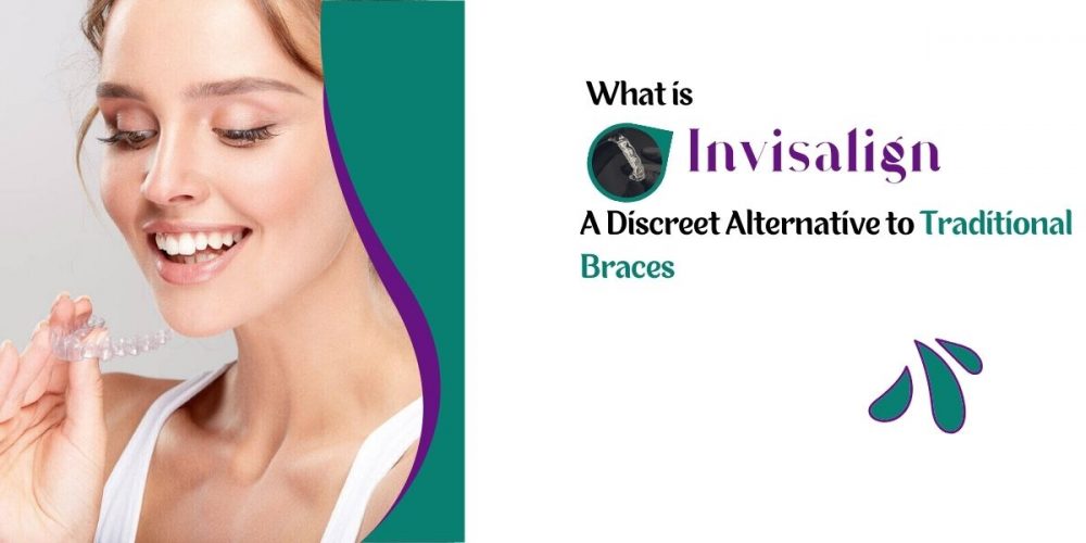 What is Invisalign A Discreet Alternative to Traditional Braces