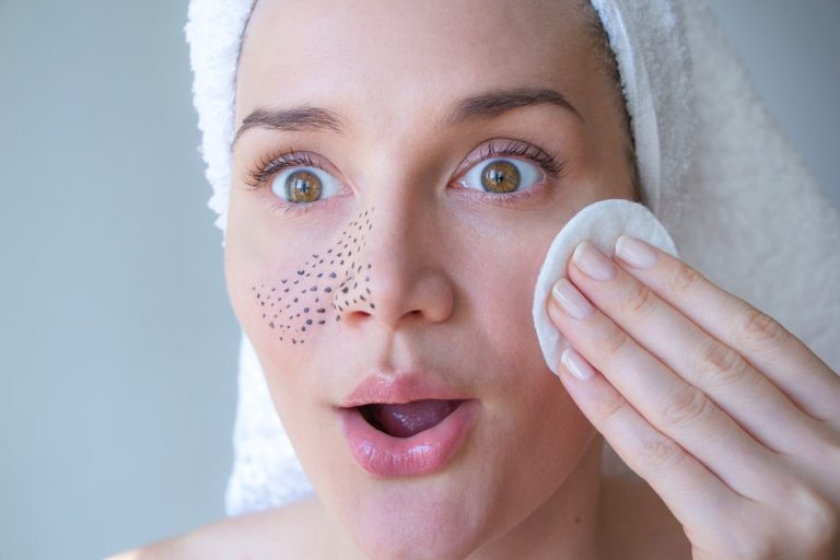 Top 5 Techniques for Removing Blackheads in Singapore