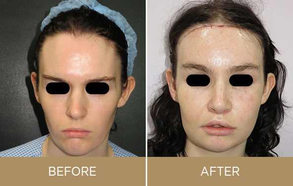 facial feminization surgery cost in USA