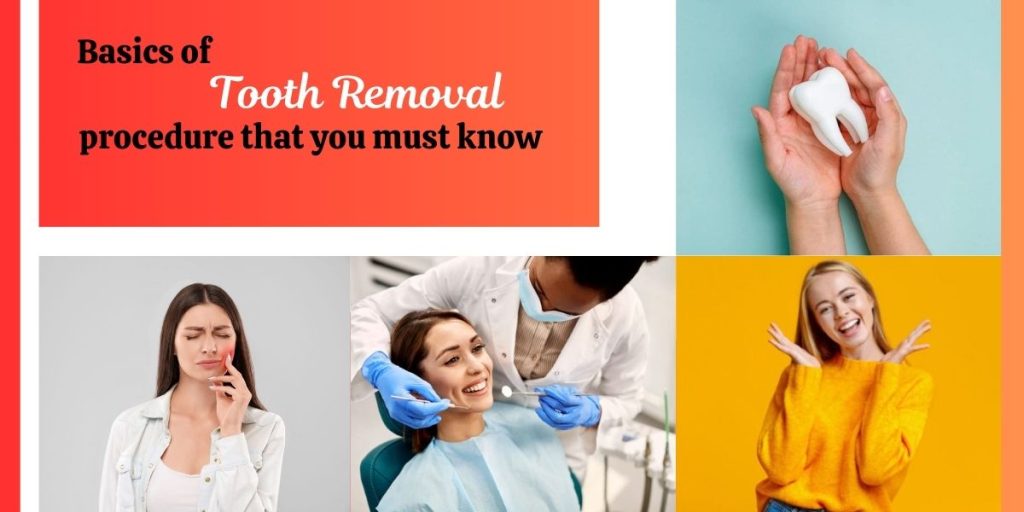 emergency tooth removal