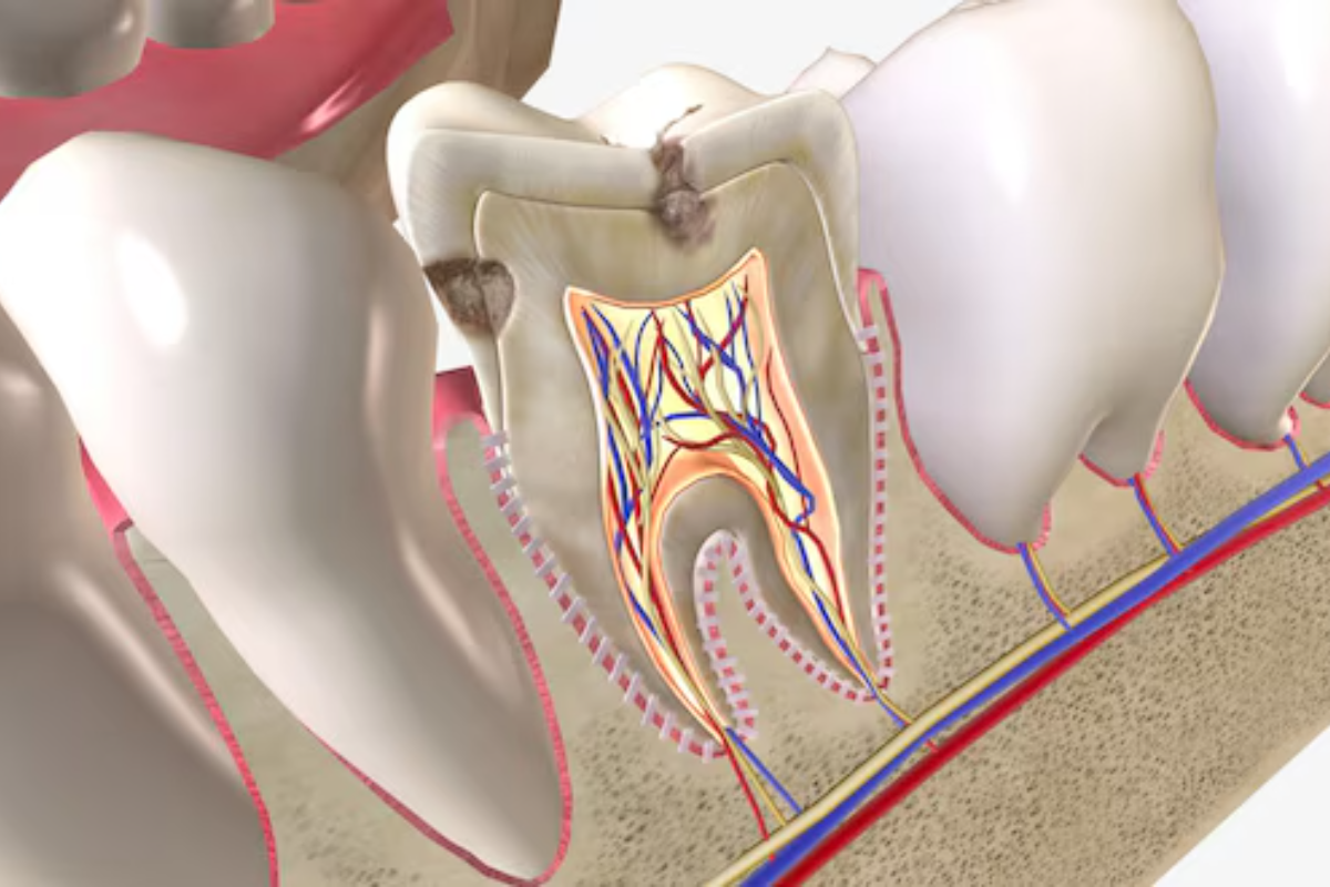 Root Canal Therapy