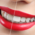 Teeth Whitening in Winnipeg