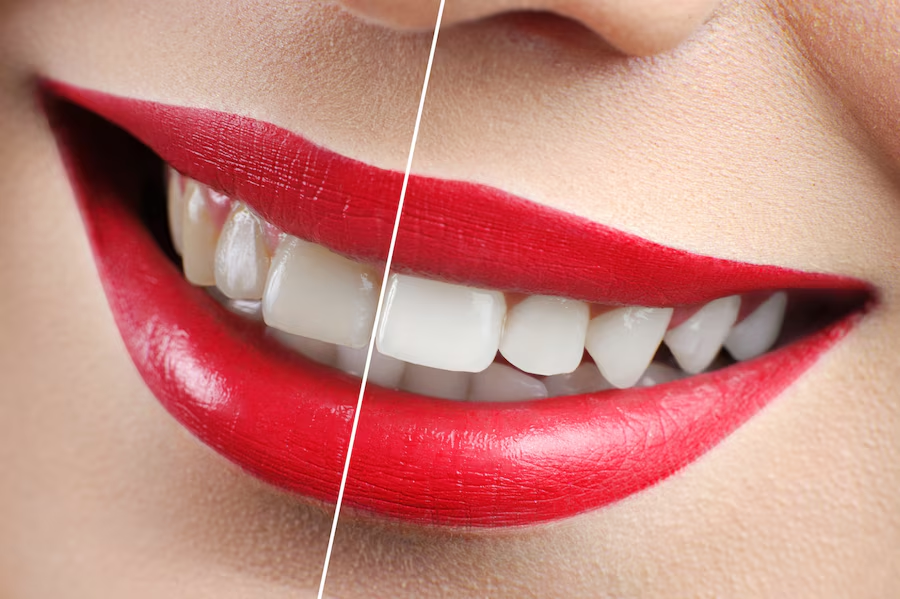 Teeth Whitening in Winnipeg