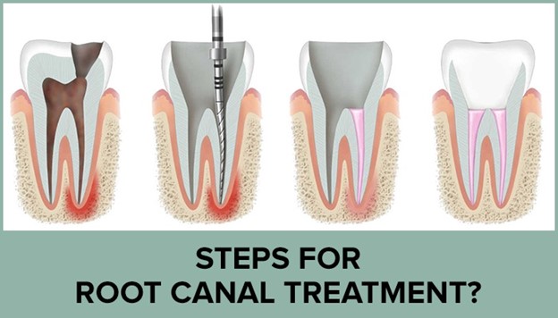 How Do You Tell If You Need A Root Canal?