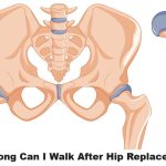 hip replacement