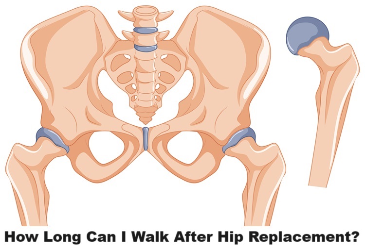 How Long Can I Walk After Hip Replacement?